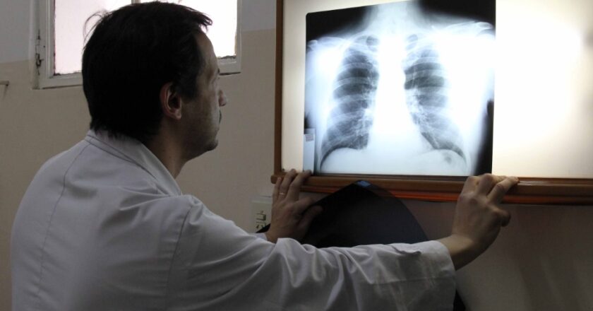 Preocupante aumento de la tuberculosis en Argentina: los casos crecieron un 65% en cinco años